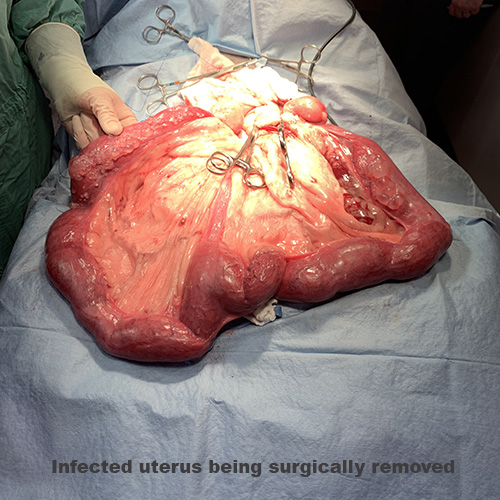 surgical removal of an infected uterus